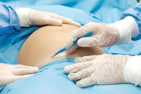 Cesarean Delivery